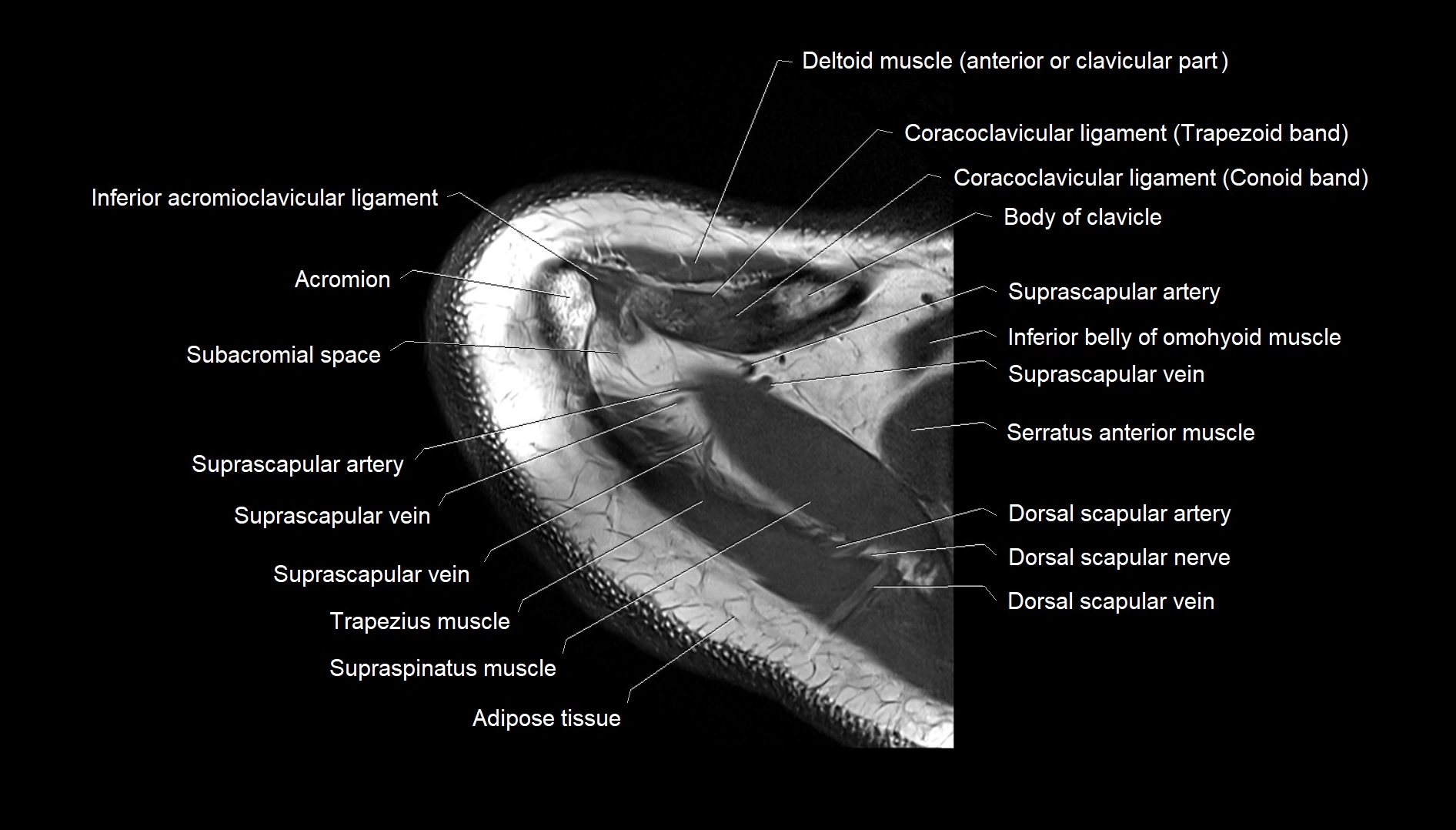 Shoulder cross sectional anatomy MRI 3T axial image 7.webp